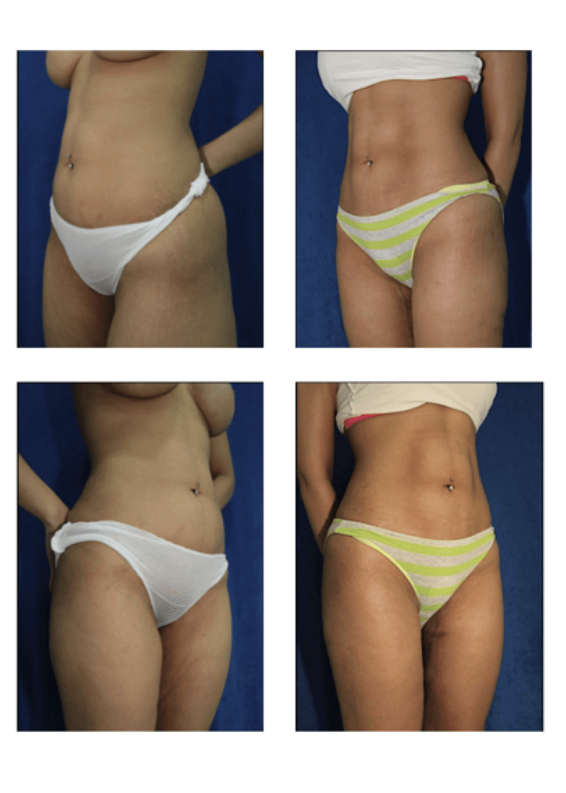 before and after